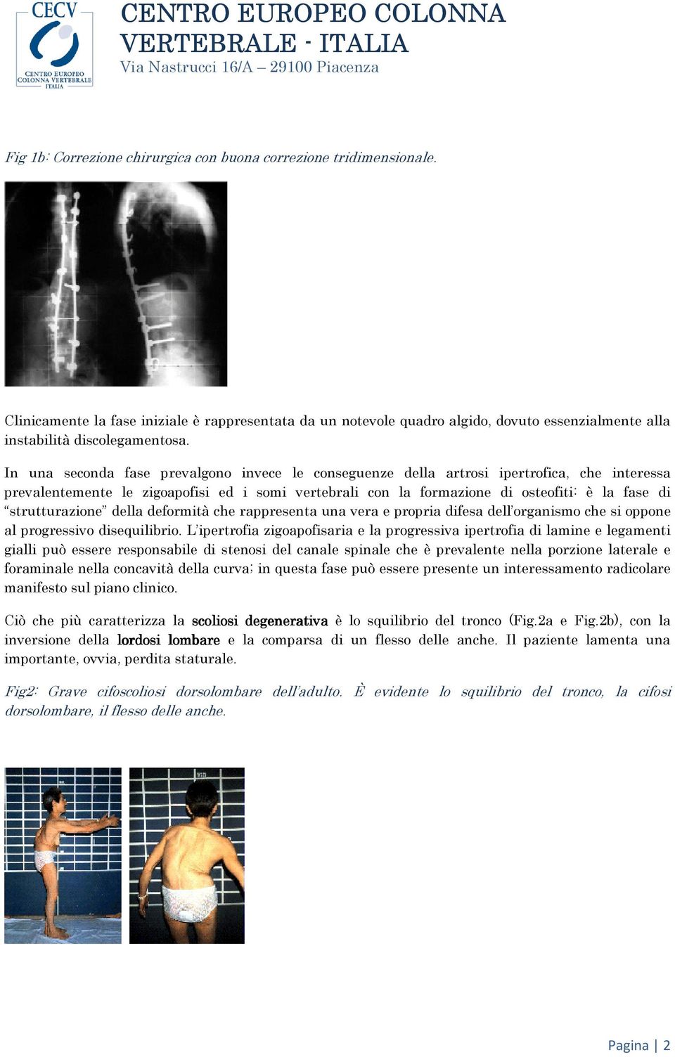 strutturazione della deformità che rappresenta una vera e propria difesa dell organismo che si oppone al progressivo disequilibrio.