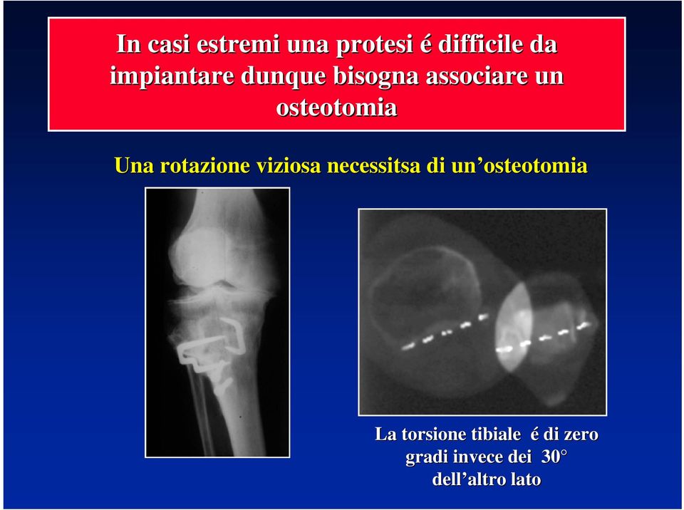 Una rotazione viziosa necessitsa di un osteotomia