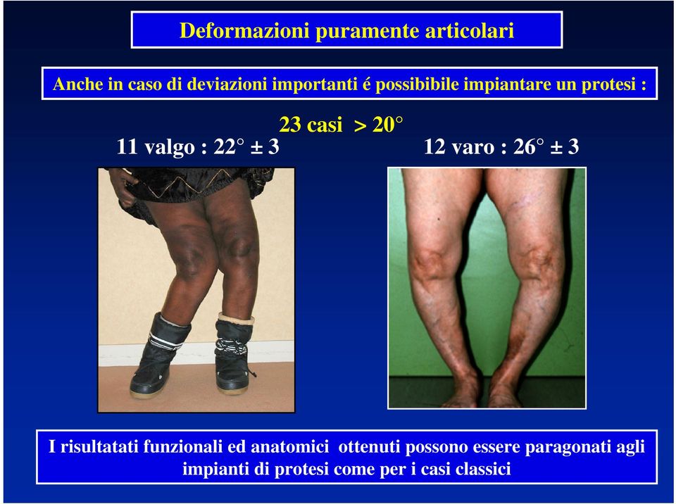 : 22 ± 3 12 varo : 26 ± 3 I risultatati funzionali ed anatomici