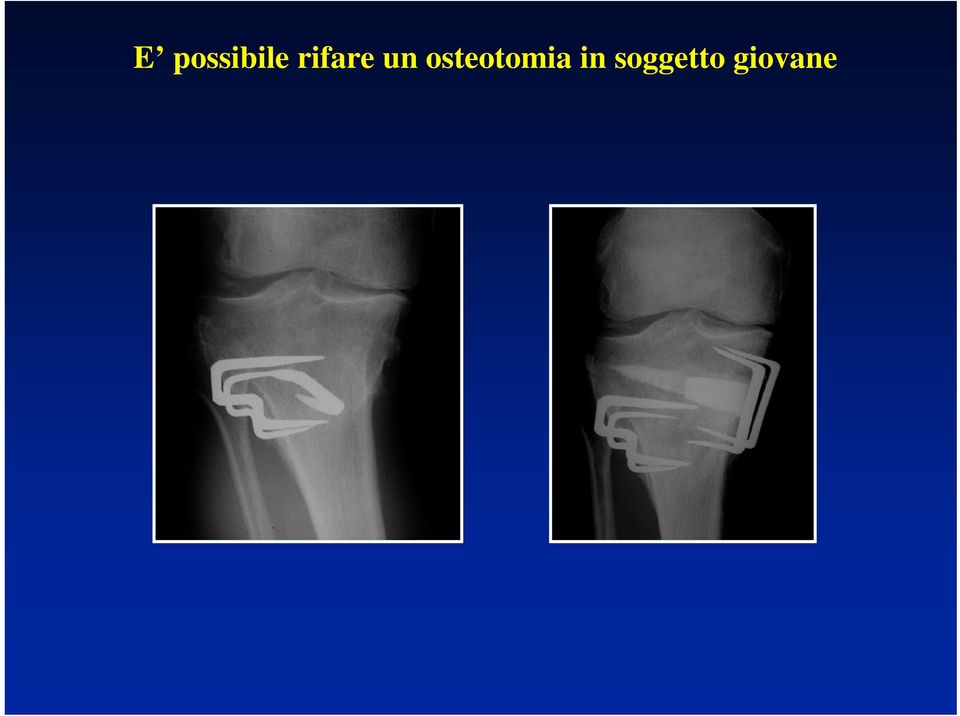 osteotomia