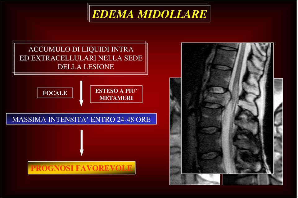 LESIONE FOCALE ESTESO A PIU METAMERI