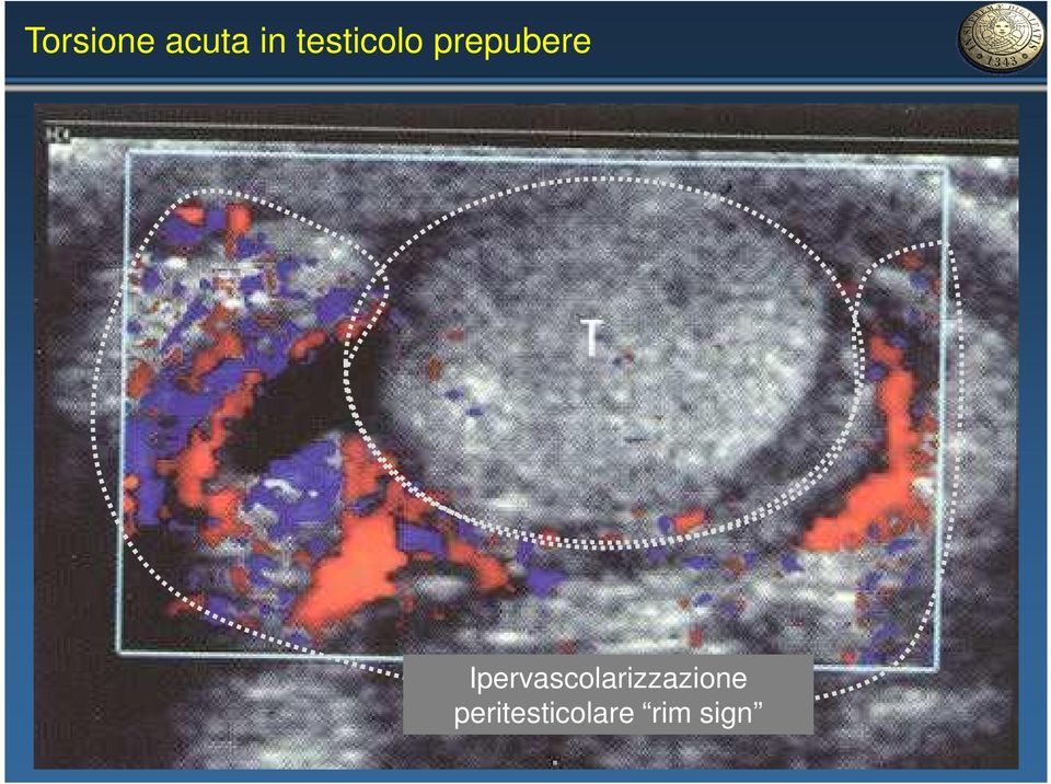 Ipervascolarizzazione testicolare