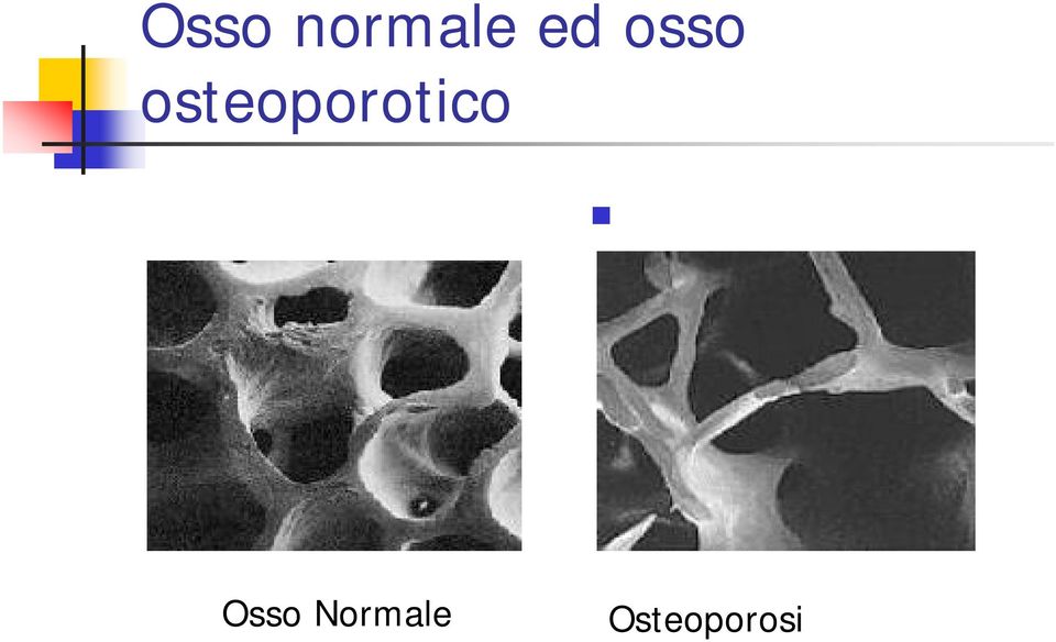 osteoporotico