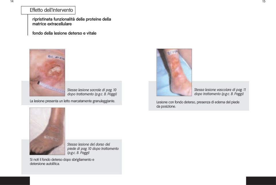 Stessa lesione vascolare di pag. 11 dopo trattamento (p.g.c. B. Paggi) Lesione con fondo deterso, presenza di edema del piede da posizione.