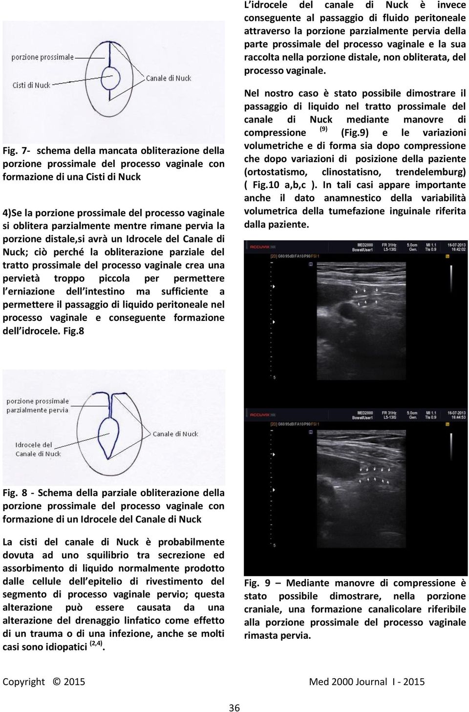 7- schema della mancata obliterazione della porzione prossimale del processo vaginale con formazione di una Cisti di Nuck 4)Se la porzione prossimale del processo vaginale si oblitera parzialmente