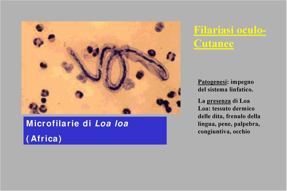 Microfilarie di Loa loa (Africa) La presenza di Loa
