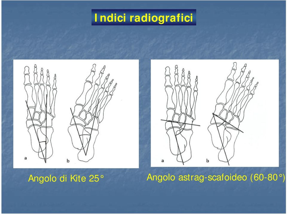 Angolo di Kite 25