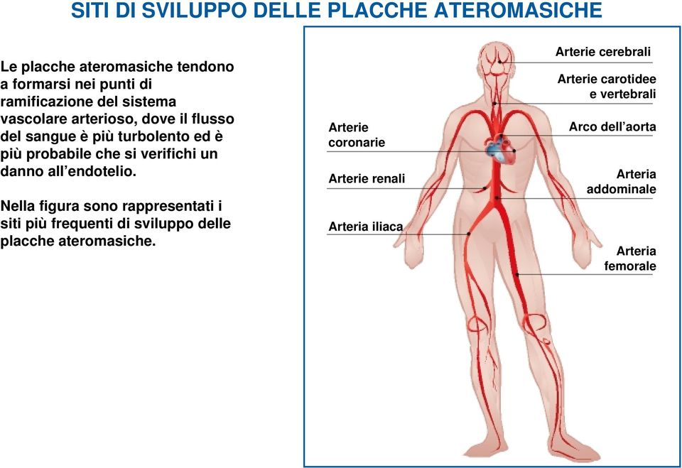 danno all endotelio. Nella figura sono rappresentati i siti più frequenti di sviluppo delle placche ateromasiche.