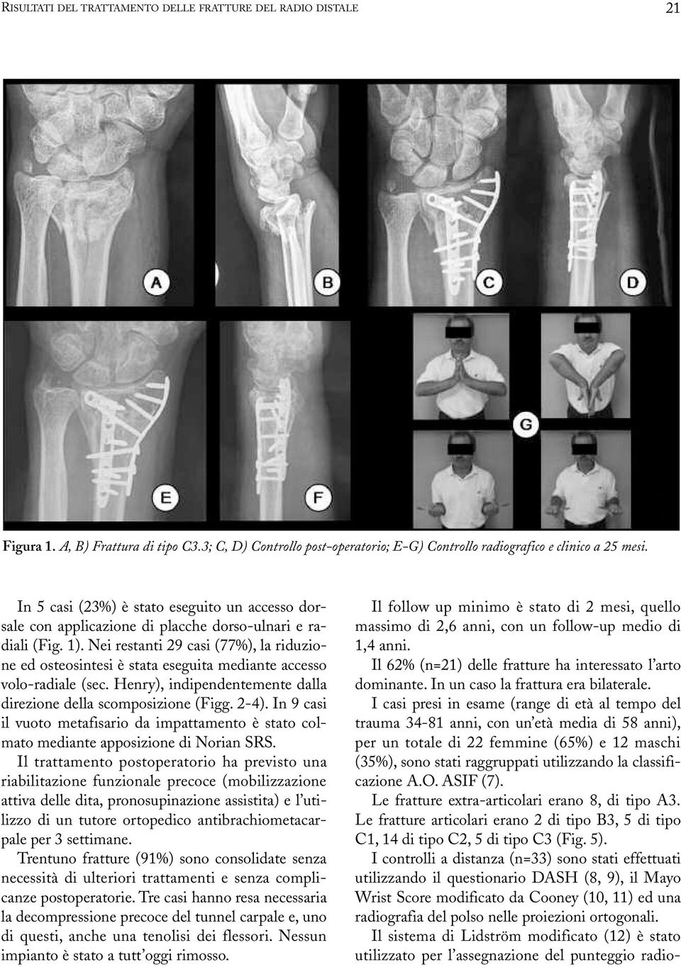 Nei restanti 29 casi (77%), la riduzione ed osteosintesi è stata eseguita mediante accesso volo-radiale (sec. Henry), indipendentemente dalla direzione della scomposizione (Figg. 2-4).