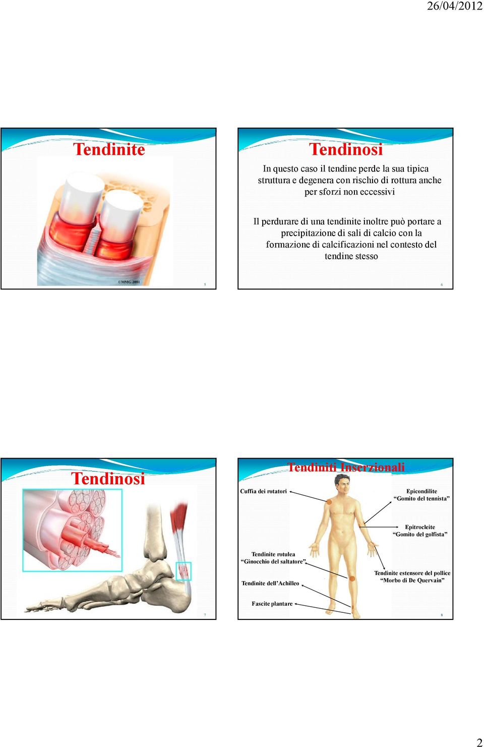 contesto del tendine stesso 5 6 Tendinosi Cuffia dei rotatori Tendiniti Inserzionali Epicondilite Gomito del tennista Epitrocleite Gomito