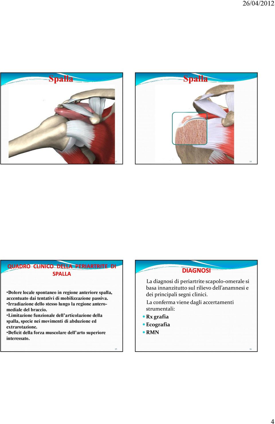 Limitazione funzionale dell articolazione della spalla, specie nei movimenti di abduzione ed extrarotazione.