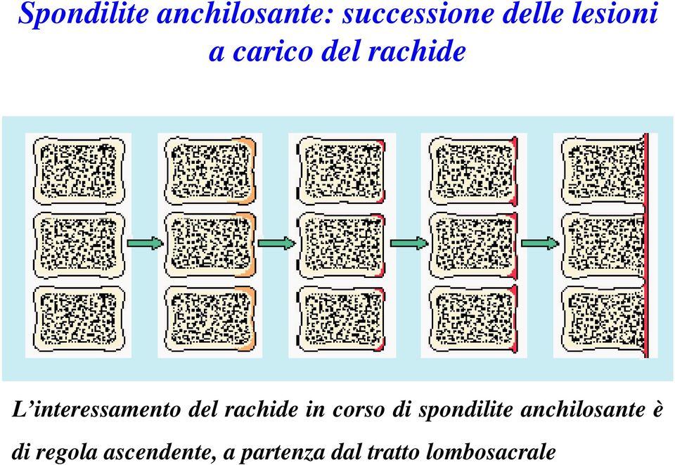 del rachide in corso di spondilite anchilosante