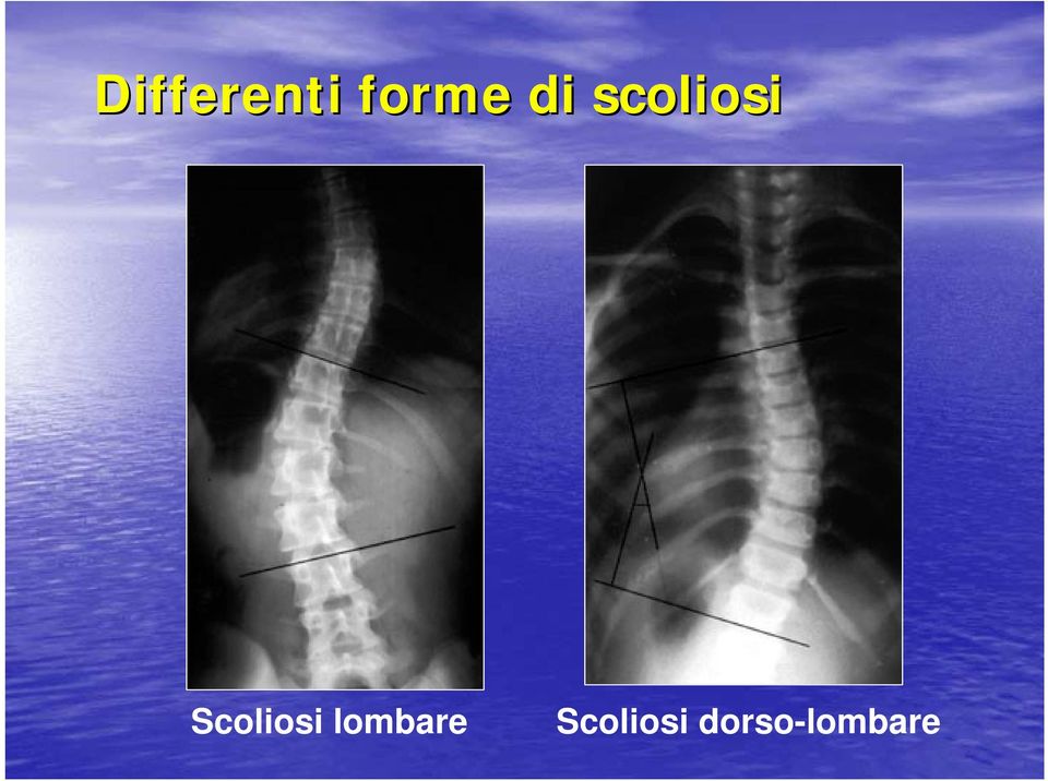 Scoliosi lombare