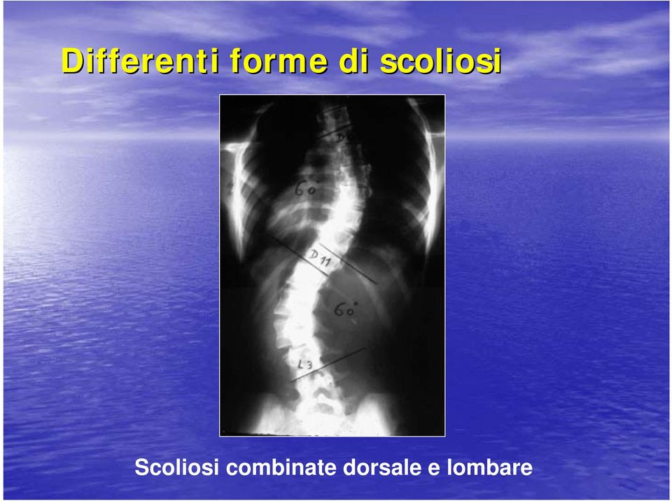 Scoliosi