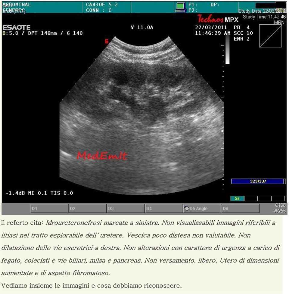 Vescica poco distesa non valutabile. Non dilatazione delle vie escretrici a destra.