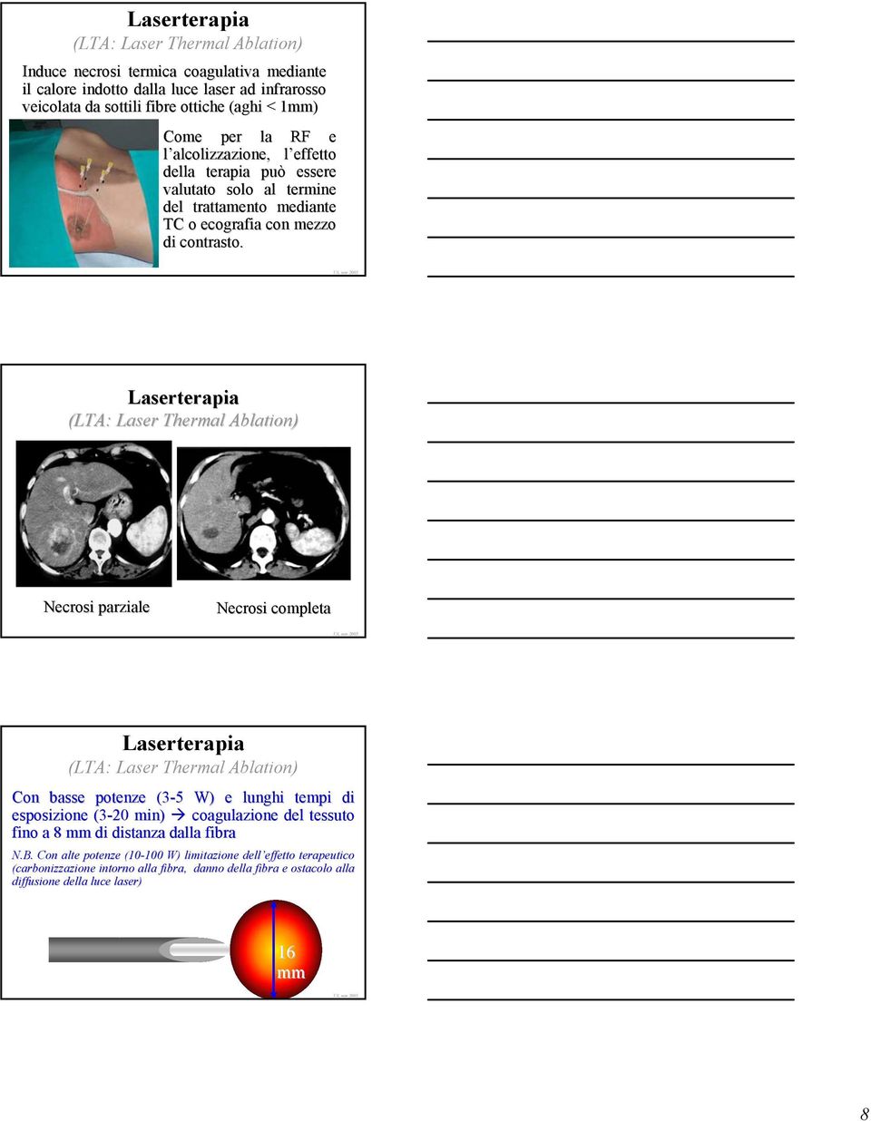 Laserterapia (LTA: Laser Thermal Ablation) Necrosi parziale Necrosi completa Laserterapia (LTA: Laser Thermal Ablation) Con basse potenze (3-5 5 W) e lunghi tempi di esposizione (3-20 min)
