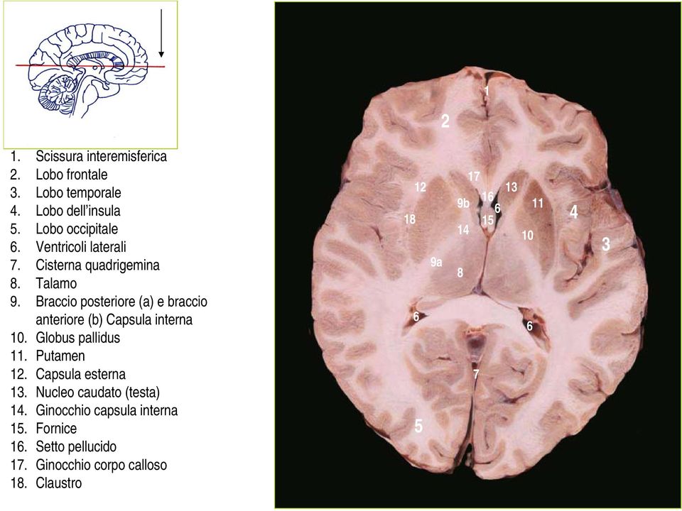 Braccio posteriore (a) e braccio anteriore (b) Capsula interna 10. Globus pallidus 11. Putamen 1.