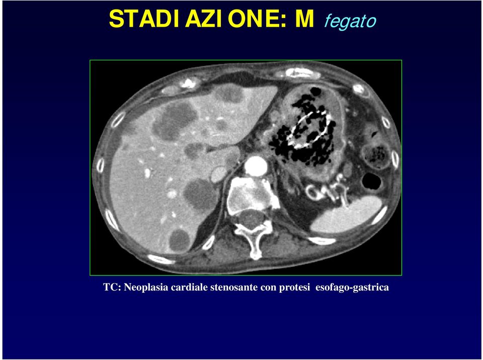 cardiale stenosante