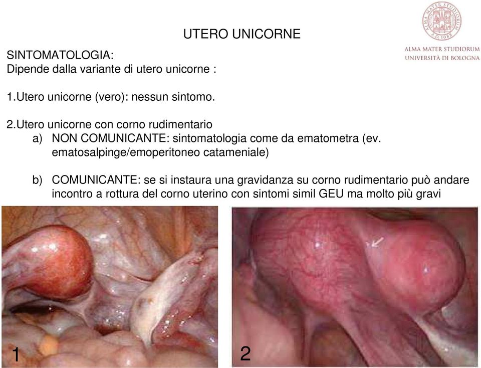 Utero unicorne con corno rudimentario a) NON COMUNICANTE: sintomatologia come da ematometra (ev.
