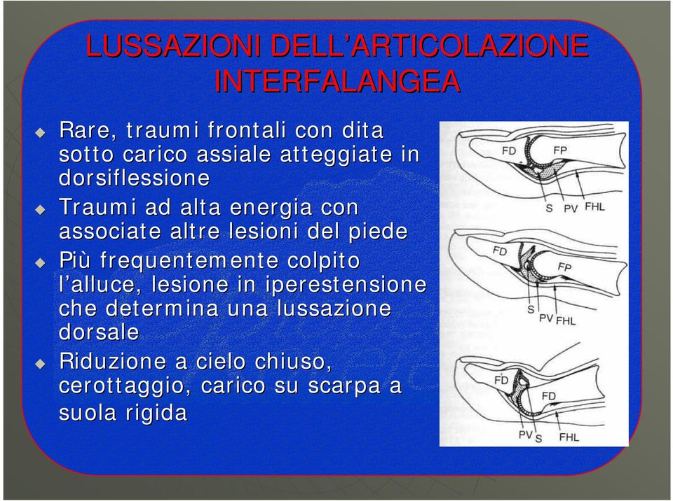 del piede Più frequentemente colpito l alluce, lesione in iperestensione che determina