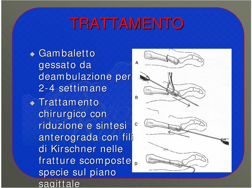 riduzione e sintesi anterograda con fili di