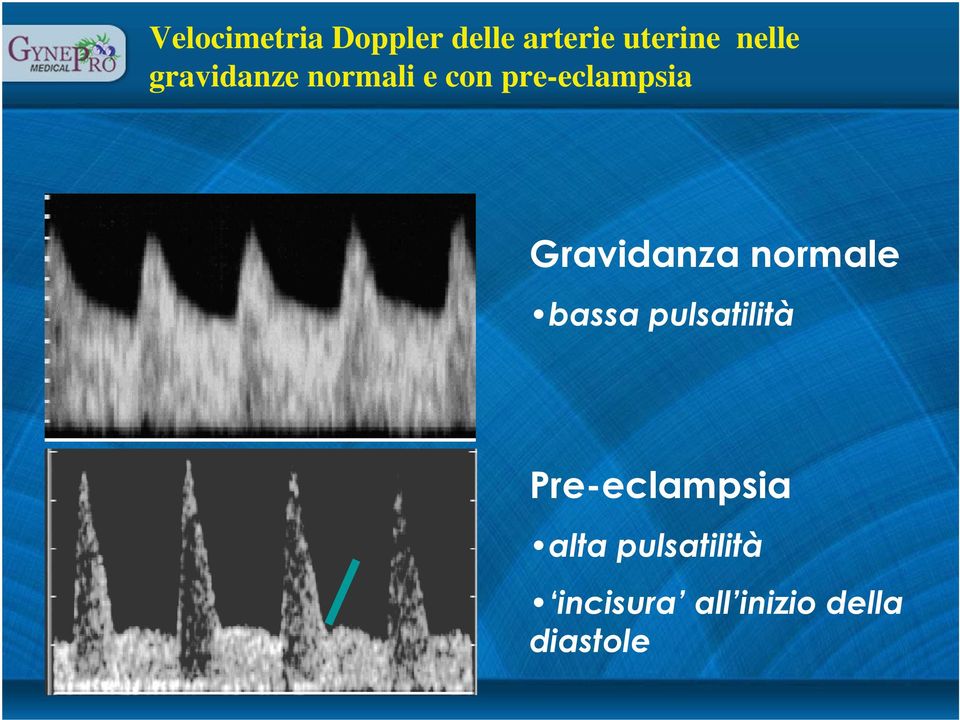 Gravidanza normale bassa pulsatilità