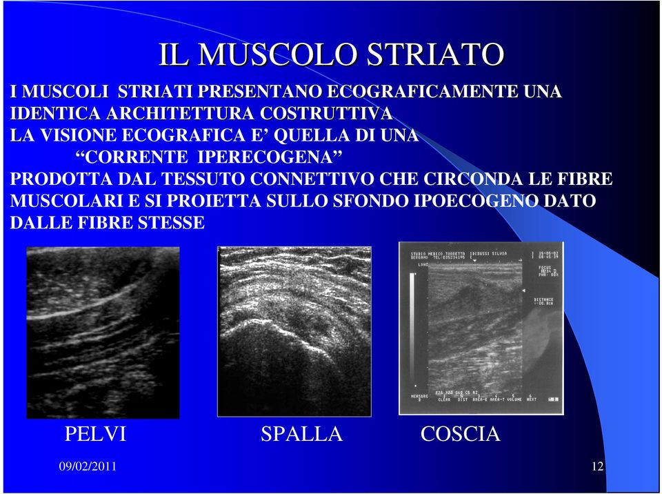 IPERECOGENA PRODOTTA DAL TESSUTO CONNETTIVO CHE CIRCONDA LE FIBRE MUSCOLARI E