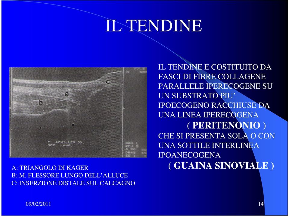 FASCI DI FIBRE COLLAGENE PARALLELE IPERECOGENE SU UN SUBSTRATO PIU IPOECOGENO RACCHIUSE