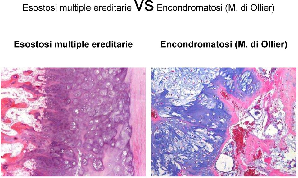 di Ollier)  Encondromatosi (M.