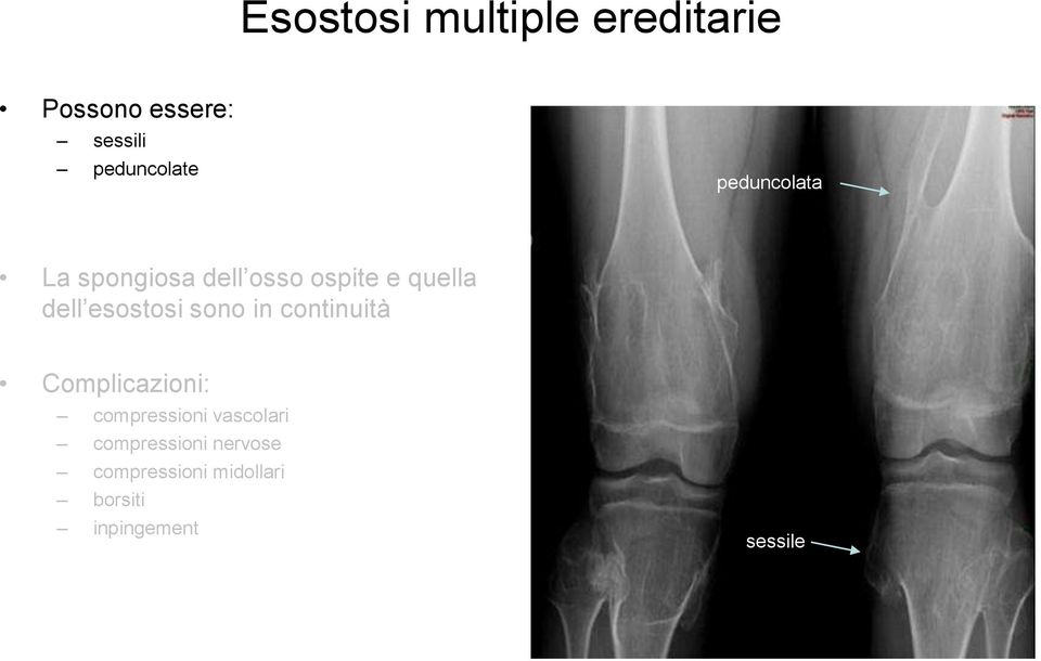 sono in continuità Complicazioni: compressioni vascolari