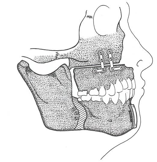 Osteotomia ed avanzamento maxillomandibolare Avanza anteriormente il massiccio faciale, il palato e la