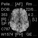 Sequenze ultra rapide: EPI (Echo Planar Imaging) La sequenza EPI è un procedimento di acquisizione delle immagini molto veloce; permette di acquisire contemporaneamente tutte le linee in una sola