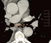 15 mm Misurazione delle lesioni tumorali alla valutazione basale (lesioni misurabili 2/2) Linfonodi patologici: per essere considerati tali devono avere il diametro minore 15 mm alla valutazione