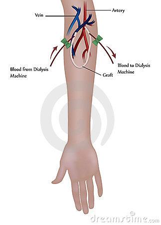 Ad un braccio del paziente viene inserito lo shunt artero-venoso: un tubicino di plastica va nell arteria radiale, l altro nella vena cefalica.