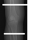 Nota: il protocollo di imaging descritto in questo manuale è da considerarsi al solo scopo di fornire le informazioni necessarie a ConforMIS per generare il design personalizzato della protesi.