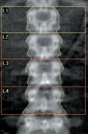 ESAMI I campi di applicazione sono molteplici: Analisi strutturata integrata dell anca e della colonna (anche in decubito laterale). Valutazione delle fratture vertebrali.