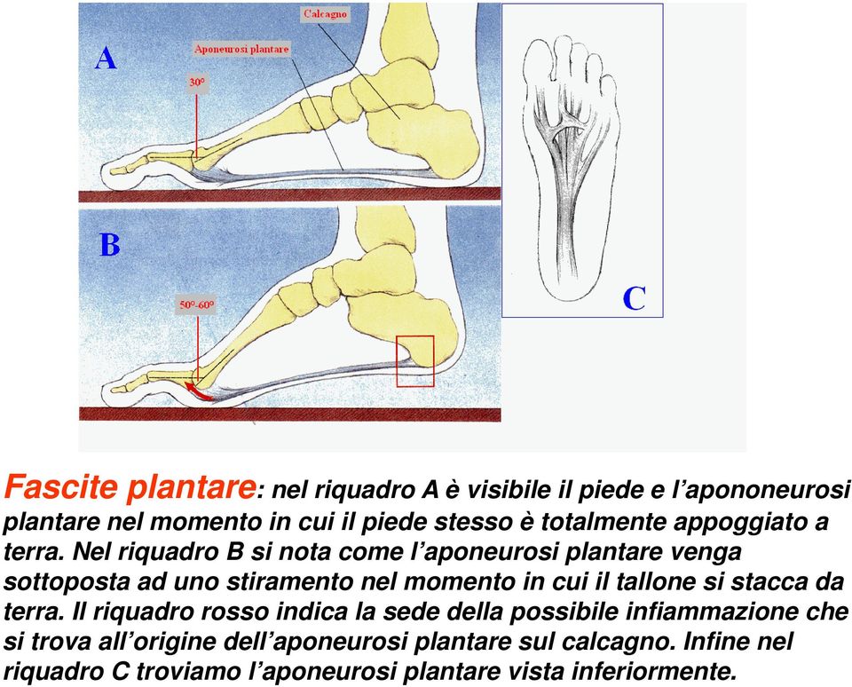 Nel riquadro B si nota come l aponeurosi plantare venga sottoposta ad uno stiramento nel momento in cui il tallone si