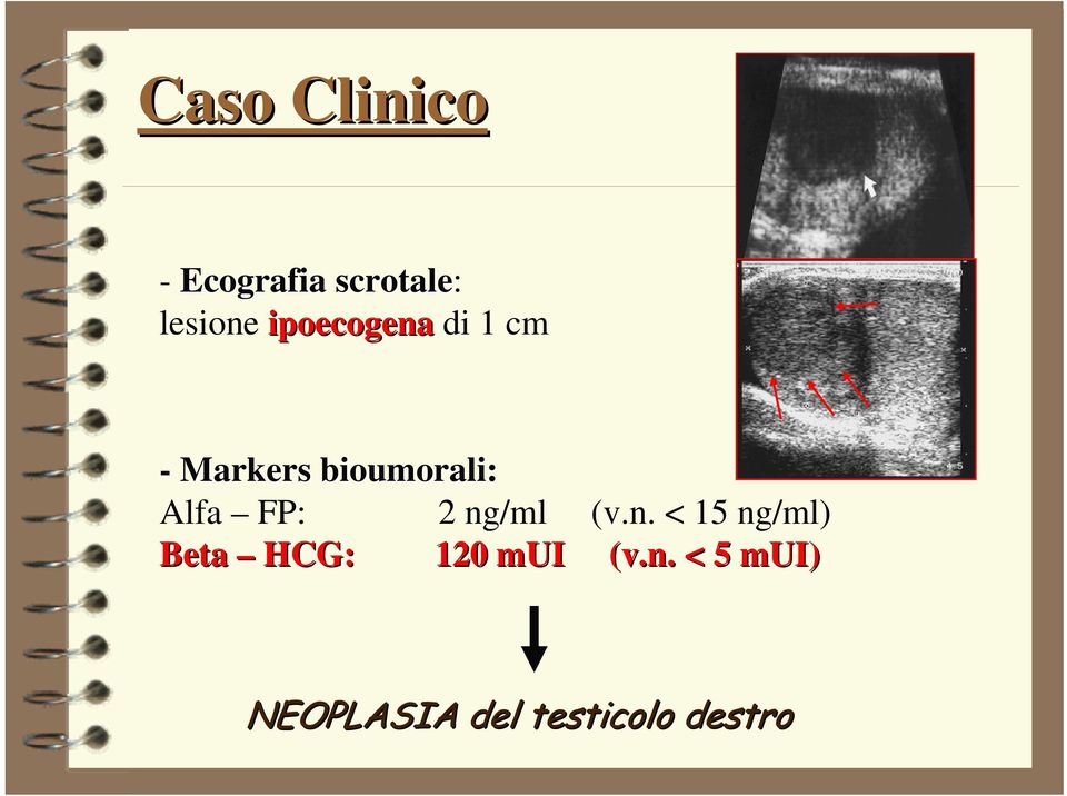 FP: 2 ng/ml (v.n. < 15 ng/ml) Beta HCG: 120 mui (v.