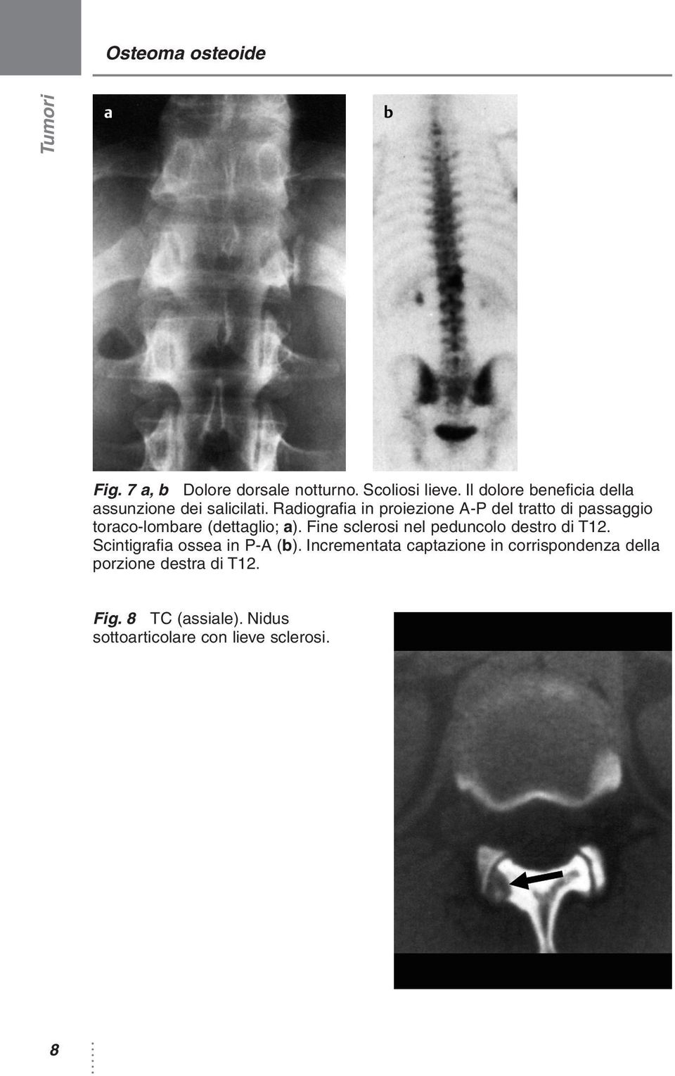 Radiografia in proiezione A-P del tratto di passaggio toraco-lombare (dettaglio; a).
