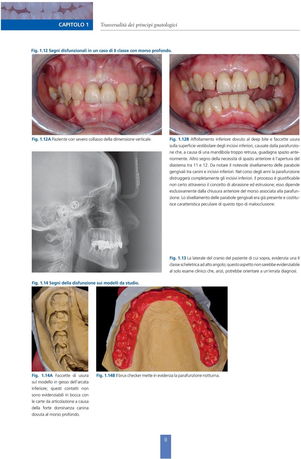 12 Segni disfunzionali in un caso di II classe con morso profondo. Fig. 1.