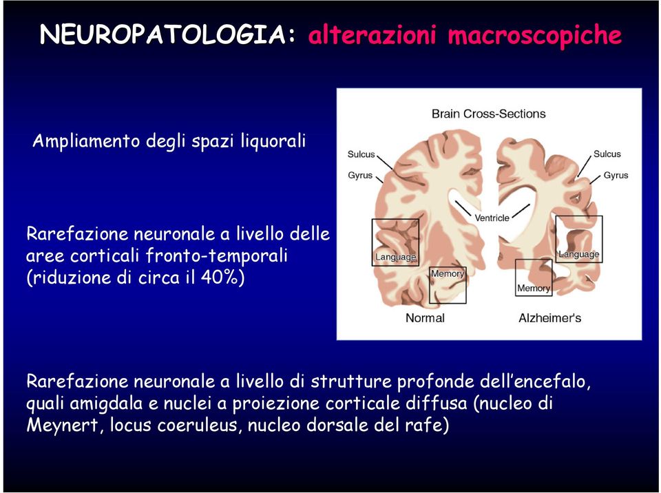 Rarefazione neuronale a livello di strutture profonde dell encefalo, quali amigdala e