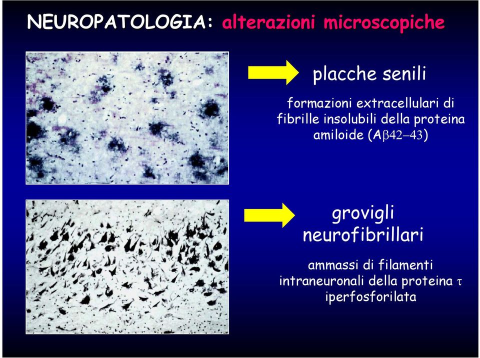 proteina amiloide (Aβ42 43) grovigli neurofibrillari