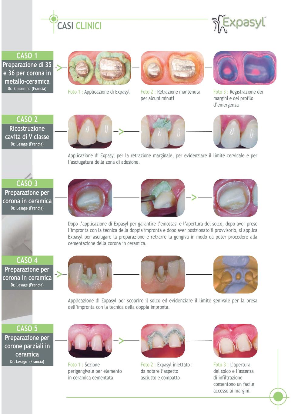 classe Dr. Lesage (Francia) Applicazione di Expasyl per la retrazione marginale, per evidenziare il limite cervicale e per l asciugatura della zona di adesione.