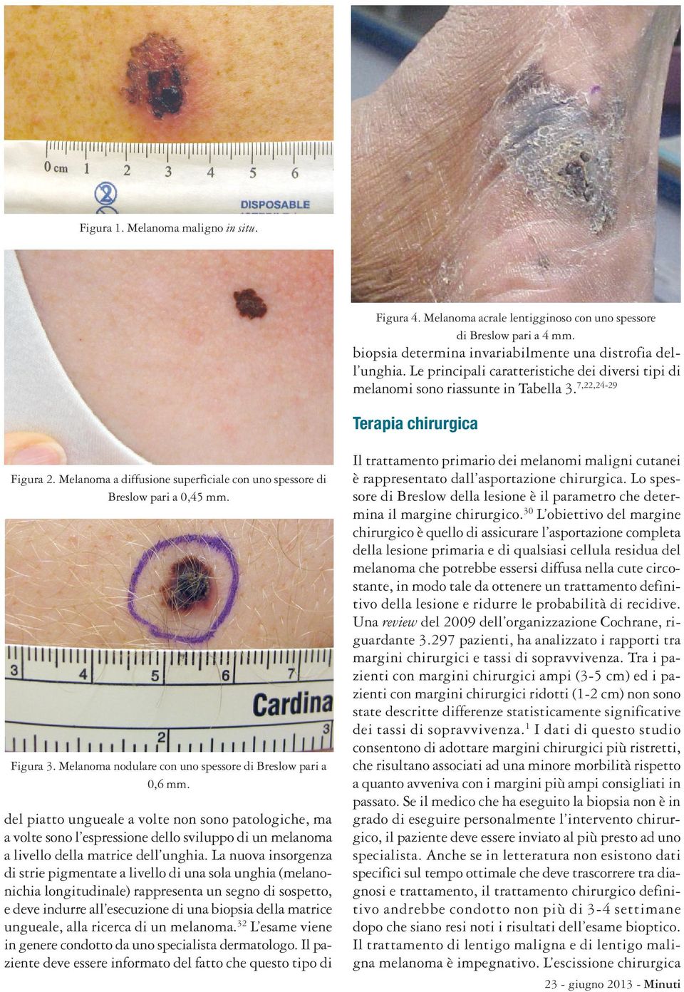 Melanoma a diffusione superficiale con uno spessore di Breslow pari a 0,45 mm. Figura 3. Melanoma nodulare con uno spessore di Breslow pari a 0,6 mm.