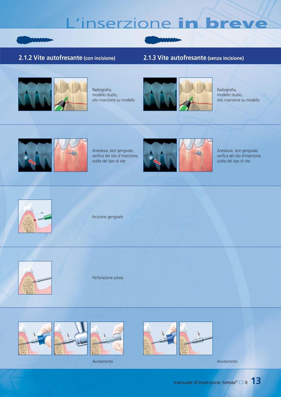 3 Vite autofresante (senza incisione) Radiografia, modello studio, sito inserzione su modello Radiografia, modello