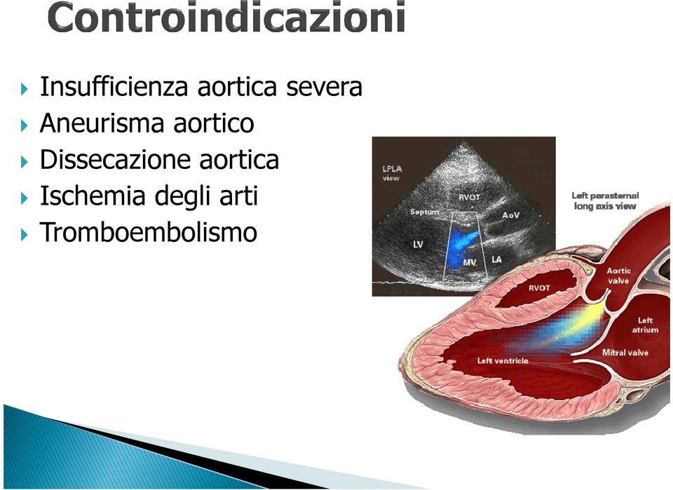 Dissecazione aortica