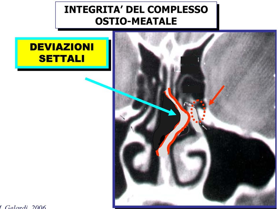 OSTIO-MEATALE