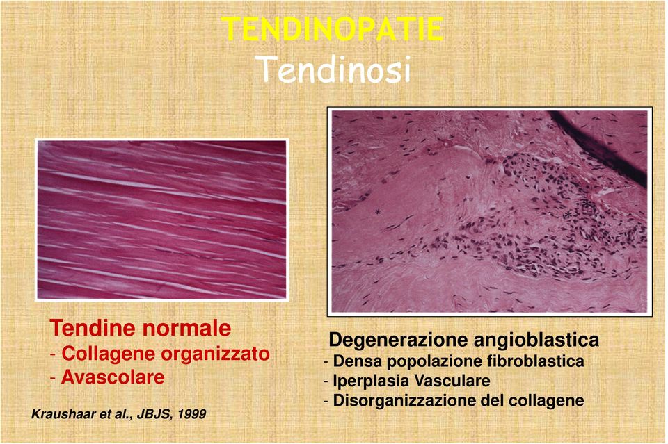 , JBJS, 1999 Degenerazione angioblastica - Densa