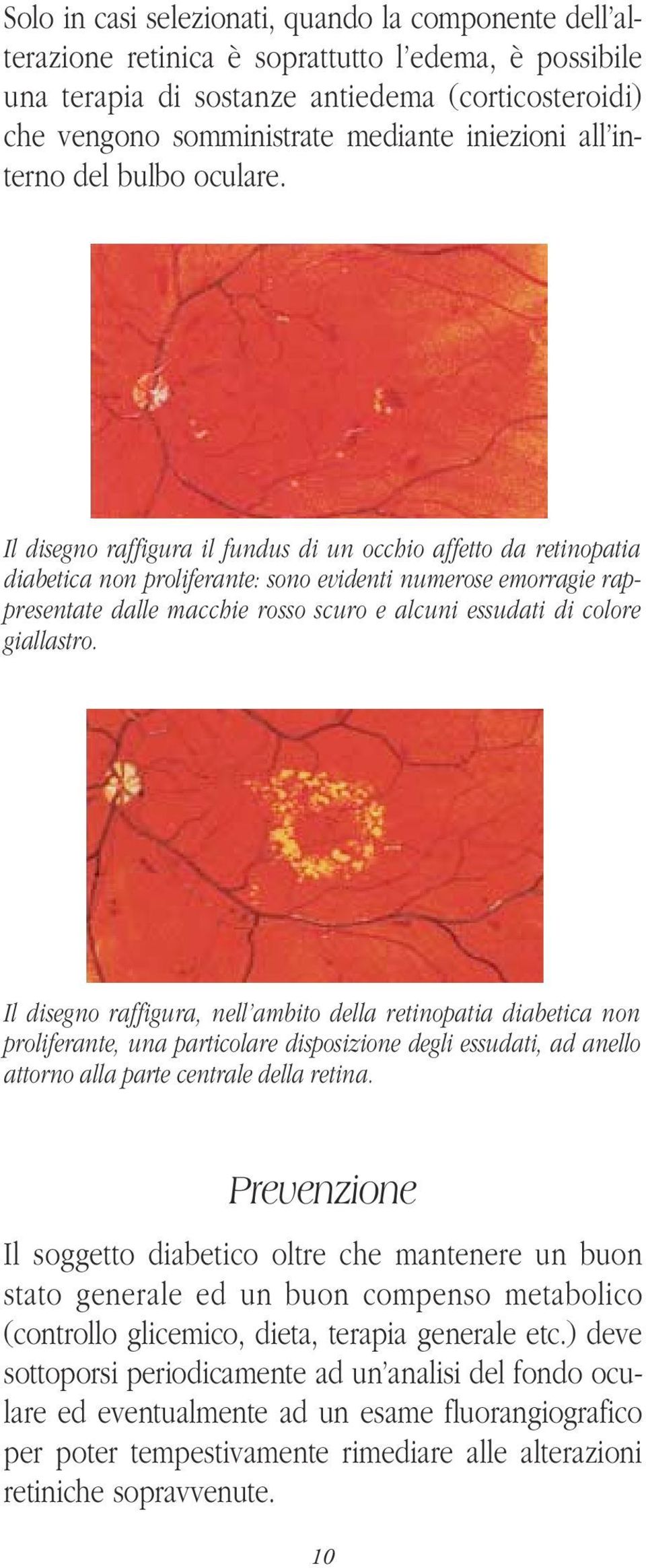 Il disegno raffigura il fundus di un occhio affetto da retinopatia diabetica non proliferante: sono evidenti numerose emorragie rappresentate dalle macchie rosso scuro e alcuni essudati di colore