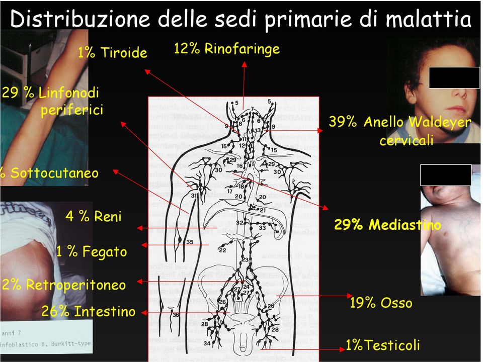 Waldeyer cervicali Sottocutaneo 4 % Reni 29% Mediastino 1